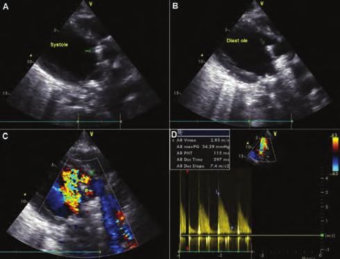 Kalp kapak hastalıkları Lipit / Koruyucu kardiyoloji Şekil. EKG de sol ana koroner arter lezyon paterni. Figure 3.