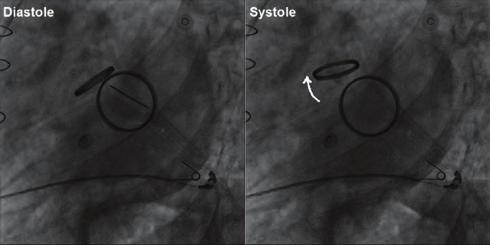insufficiency (C) with aortic regurgitan PHT of 5 ms (D). Şekil. Sol ana koroner arter osteal lezyonu. Şekil 3. Sağ koroner arter osteal lezyonu. Figure 4.