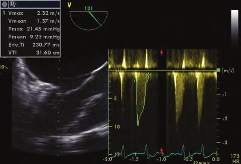 Transtorasik ekokardiyografide interatriyal septumda primum tip atriyal septal defekt, sağ kalp boşluklarında genişleme ve miksamatöz mitral kapak izlendi (Şekil 3).