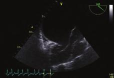 5 cm boyutunda primum tip atriyal septal defekt ve geniş patent foramen ovale izlendi (Şekil 4), ayrıca mitral kapaklar miksamatoz yapıda olup hafif mitral yetersizliği izlendi.