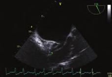 Kalp damar cerrahisi tarafından median sternotomi sonrası aortik-bikaval kanülasyon tekniğiyle orta dereceli hipotermi altında kardiyopulmoner bypass kullanılarak sağ atriyotomi yapılması ardından