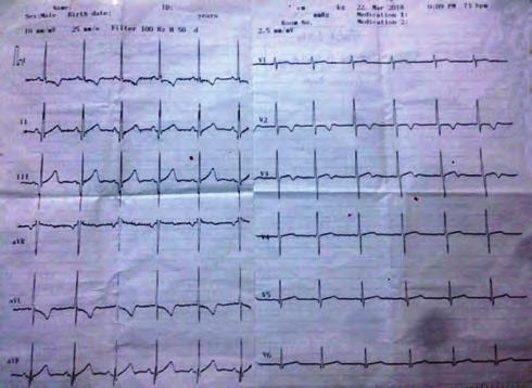 Kalp kapak hastalıkları OPS-66 Şekil 5. Mitral flail olarak saptanan segmentin transozafagial ekokardiyografide görünümü (trans gastrik inceleme 0 derece). Kalp yetersizliği OPS-65 Şekil 7.