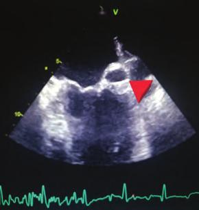 Kalp kapak hastalıkları Kalp kapak hastalıkları Şekil 5. Transözefageal ekokardiyografi de aort pozisyonda homogreft kapak.