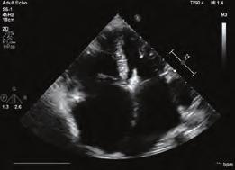Konjenital kalp hastalıkları Kalp yetersizliği of associated cardiac anomalies, such as atrial septal defect, bicuspid aortic valve, coarctation of aorta, coronary sinus ostial atresia, and cor