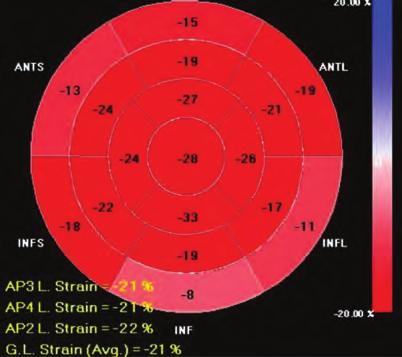 We found no other pathological findings in our patient, but this anomaly unusually caused right heart failure symptoms with right heart dilation.