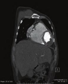 Physical Examination shows tachycardia, crackles and decreased respiratory sounds in the bases of the lungs, upper right quadrant sensitivity, hepatomegaly. Chest x-ray shows pleural effusion.