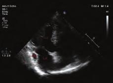 Transthoracic echocardiogram (TTE) revealed 8x mm midventricular VSD which was limited by myocardial tissue on the right ventricular side. There was no left to right shunt.