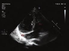 different mechanisms play role in closing of a VSD.Muscular types of VSDs have more chance to close than perimembraneous and membraneous types.