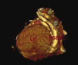 The defect size in our patient is larger than the defects which are usually prone to close in the trials.. Moreover, if we also consider the crypts, our defect can be accepted larger.