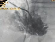 3-D bilgisayarlı tomografi görüntüsü CS: Koroner sinüs LV: Sol ventrikül PSSVC: Persistan sol süperior vena cava. Koroner arter hastalığı / Akut koroner sendrom OPS-76 OPS-75 Figure.