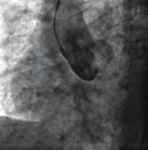 Bu olgu sunumumuzda çok nadir bir anomali olan assendan aorta orjinli RCA olgusunu sunduk. Olgu: Elli altı yaşında erkek hasta tarafımıza göğüs ağrısı ile başvurdu.