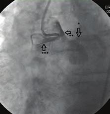 Hastanın yapılan koroner anjiografisinde, sol sistemde anlamlı darlık bulunmamasına karşın (Şekil ) çeşitli enjeksiyonlar veya pig tail kateter ile yapılan aortograma rağmen sağ koroner arter