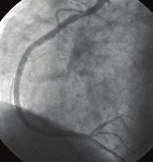 Ertesi gün tekrar koroner anjiografiye alınan hastanın assendan aortada, sol koroner arterle aynı hizada ve üst seviyeden kaynaklanan sağ koroner arter ostiumu gözlendi. 6F JL 3.