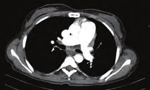 Bedside echocardiography revealed right ventricle enlargement, severe tricuspidal regurgitation and a suspicious thrombus image in left pulmonary artery.