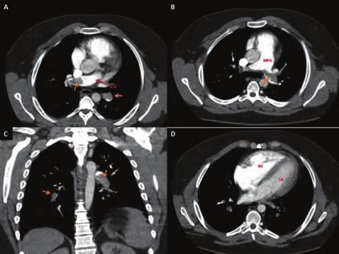 To clarify the diagnosis, thorax computerized tomography with contrast injection was planned. It demonstrated bilateral massive pulmonary thromboembolism.
