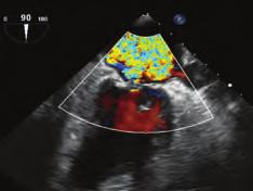 Kardiyak görüntüleme / Ekokardiyografi Kardiyak görüntüleme / Ekokardiyografi OS-5 Severe mitral valve regurgitation after aortic valve surgery: What is the reason?