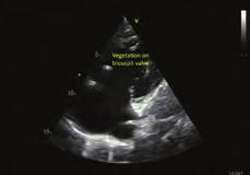 The function of prosthetic aortic valve and left ventricular ejection fraction were normal and transesophageal (TEE) echocardiography was done for detailed evaluation.