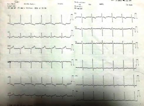 Left main coroner artery (LMCA): normal, left anterior descending artery (LAD): proksimal %40, distal en dar yeri %90 diffüz darlık, circumflex artery (CX): proksimal %50 darlık, right coroner artery