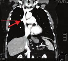 Pulmoner hipertansiyon / Pulmoner vasküler hastalık Koroner arter hastalığı / Akut koroner sendrom venin açıldığı görülmektedir.