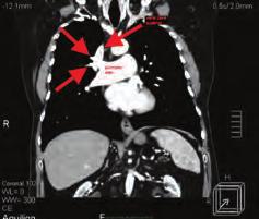Dolayısıyla pulmoner hipertansiyonu bulunan sağ kalp boşlukları geniş bir hastada transözefagial ekokardiyografide ASD veya anormal pulmoner venöz drenaj görülmese bile Qp/Qs oranının yüksek