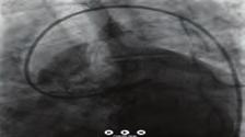 Koroner arter hastalığı / Akut koroner sendrom Şekil 6. 3.0x9 mm NC Balon ile POT yapıldı. Şekil 7. Çoklu balon sonrası görülen lezyon.