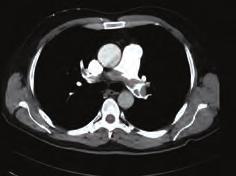 Pulmoner hipertansiyon / Pulmoner vasküler hastalık Koroner arter hastalığı / Akut koroner sendrom OPS-9 Sistemik trombolitik tedavinin kontraendike olduğu masif pulmoner emboli hastalarında