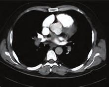 Kliniği, İstanbul Amaç: Masif pulmoner emboli zamanında ve uygun tedavi edilmez ise mortalitesi yüksek (%5-50) bir acil durumdur.