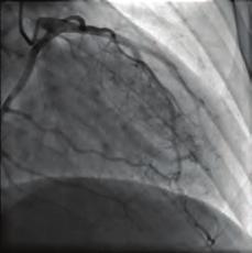 Patients are generally asymptomatic,but coronary artery microfistulas can cause serious cardiac complications such as angina pectoris (most commonly symptom), myocardial infarction, congestive heart