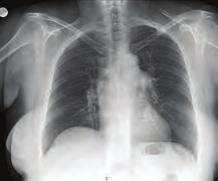 Pulmoner hipertansiyon / Pulmoner vasküler hastalık Koroner arter hastalığı / Akut koroner sendrom Figure.