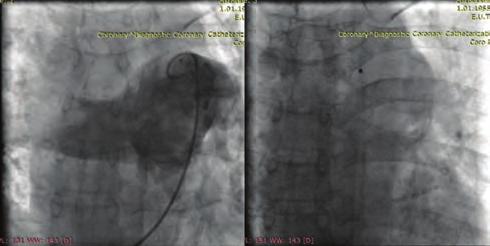 Right coronary angiogram revealed single coronary ostium and left main coronary artery arising from right coronary artery (Figure ).