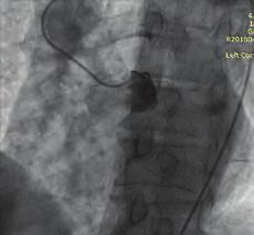 Although variety of coronary anomaly has been described, SCA is very rare condition. The prevalence of SCA is nearly 0.04%.