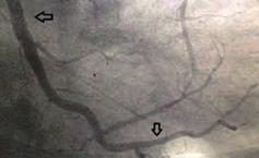 Koroner arter hastalığı / Akut koroner sendrom Koroner arter hastalığı / Akut koroner sendrom PPCI was planned and in the coronary angiogram, a high volume dense non-occlusive thrombus was detected