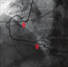 Four hours later, coronary angiography was performed again and total resolution of the thrombus in the circumflex artery was observed (Figure ).