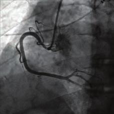 In conclusion, in select cases with STEMI and high thrombus burden allowing distal coronary flow, intravenous thrombolytic treatment may be chosen instead of primary stenting to decrease coronary