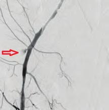 Koroner arter hastalığı / Akut koroner sendrom Koroner arter hastalığı / Akut koroner sendrom Şekil 4. Femoral kanama.