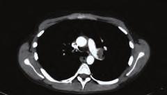 Toraks bilgisayarlı tomografisinde (CT) her iki pulmoner arter proksimalinden segment dallarına kadar uzanan trombüs ile uyumlu dolma defekti izlendi (Şekil -).