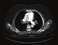 Şekil. Şekil 3. Koroner arter hastalığı / Akut koroner sendrom Şekil 5. Greft stent sonrası femoral arter. Şekil. Şekil 4. tedavi kullanımı söz konusudur.