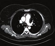 Pulmoner hipertansiyon / Pulmoner vasküler hastalık Koroner arter hastalığı / Akut koroner sendrom tibiyotikler (vankomisin, rifampisin gibi), nonsteroidal antiinflamatuvar ilaçlar ve düşük molekül