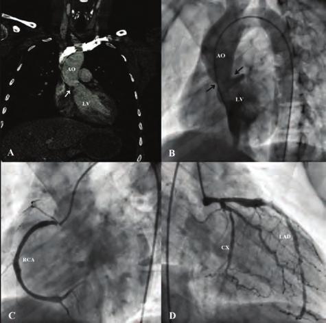 Lipit / Koruyucu kardiyoloji Koroner arter hastalığı / Akut koroner sendrom Figure. LMCA thrombus. Figure. Thrombus resolution. OS-9 Şekil. Olgu : Konvansiyonel ve BT anjiogram.