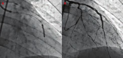 Koroner arter hastalığı / Akut koroner sendrom Pulmoner hipertansiyon / Pulmoner vasküler hastalık were consistent with acute PE.