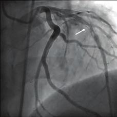 a Figure 4. Final LAD artery view before CABG surgery.