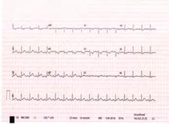 branch was totally occluded (Figure 4a and 4b). Balloon predilatation and stent implantation was performed successfully to both lesions (Figure 5a and 5b).