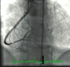 Özkan, Servet Altay, Fulya Puyan Department of Cardiology, Trakya University Faculty of Medicine, Edirne Department of Pathology, Trakya University Faculty of Medicine, Edirne Figure.