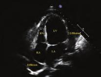 Hipereozinofili ile birlikte organ tutulumu olmasına (%69 dermatolojik, %44 pulmoner %38 GİS, %0 kardiyak (miyoperikardit, kapak tutulumu, trombüs)) veya organ tutulumu olmadan 6 ay süre ile yüksek