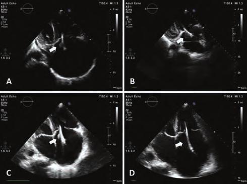 the appearance of an intense spontaneous echo contrast (C) Mid-esophageal short-axis view (30 60 ), thrombus in the left atrial appendage has completely resolved.