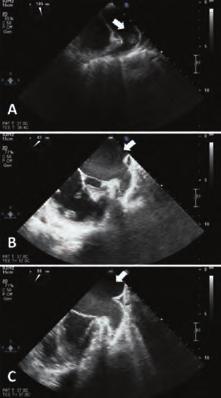 OS-8 Development of pacemaker lead thrombosis in a patient with atrial fibrillation during apixaban treatment Adem Adar Department of Cardiology, Karabük University Faculty of Medicine, Karabük