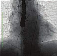 yaşında kadın hasta yıl önce üçlü koroner bypass operasyonu (LIMA-LAD, Ao-OM safen ve Ao-RCA safen) mevcut olup ciddi kalsifik aort stenozu nedeniyle kalp konseyi neticesinde TAVİ kararı alındı.