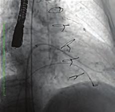 Kalsifik kapak AL, AL ve JR4 kateterler ile düz uçlu PTFE ve hidrofilik tellerle operatör tarafından 30 dk uğraşılmasına rağmen geçilemedi. Bunun üzerine TEE eşliğinde atrial septostomi yapıldı.