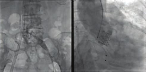 it is extremely difficult to perform emergent surgical aortic valve replacement. Performing TAVI as an emergent procedure can be another option, but there are few reported cases.