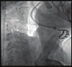 Discussion: SAS with acute decompensation which can not medical treated, are could undergo to baloon valvuloplasty(bav), which is known to have limited success, restenosis and clinical deterioration